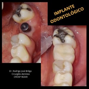 Implante - Antes e Depois - Clínica Kraid