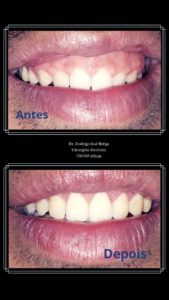 Gengivoplastia - Antes e Depois - Clínica Kraid