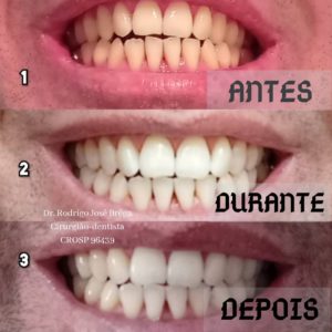 Clareamento Dental - Antes e Depois - Clínica Kraid