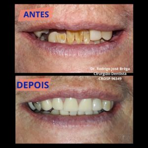 Próteses - Antes e Depois - Clínica Kraid