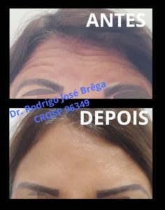 Harmonização Facial - Clinica Kraid - Antes e Depois