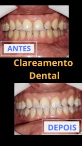 Clareamento Dental - Clínica Kraid - Antes e Depois