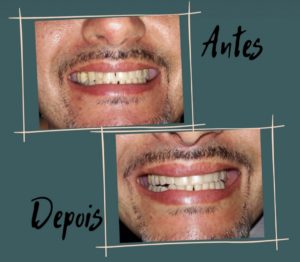 Lentes de Contato - Antes e Depois - Clínica Kraid