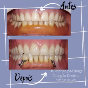 Próteses - Antes e Depois - Clínica Kraid