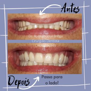 Próteses Dentárias - Clínica Kraid - Antes e Depois